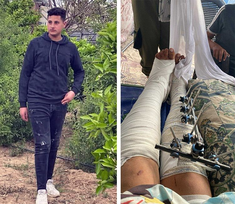 Hamas thugs shattered the legs of 16-year-old Waleed Abu Abed in Khan Younis, Gaza, then said they got the wrong person. Hamas is moving to reestablish its brutal dictatorship.